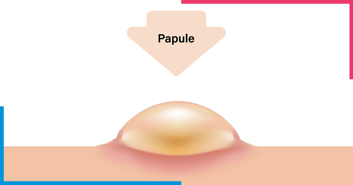 Papule-skiinaceclinic