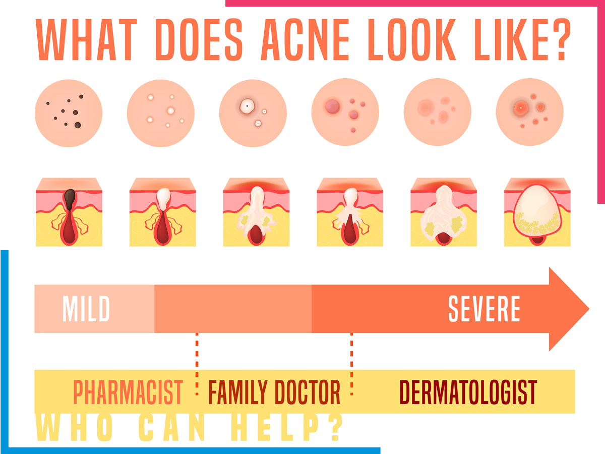 Types-of-acne-skiinaceclinic