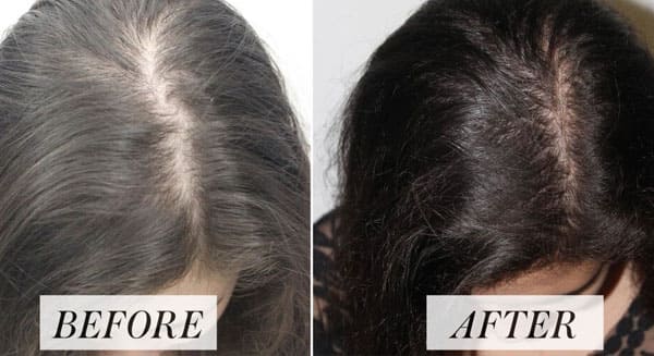 Hair Fall/Loss Treatment